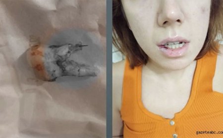 Kanal Tedavisinde Şok İddia