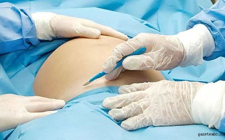 Sezaryen Sonrası Ölümde Doktor Serbest