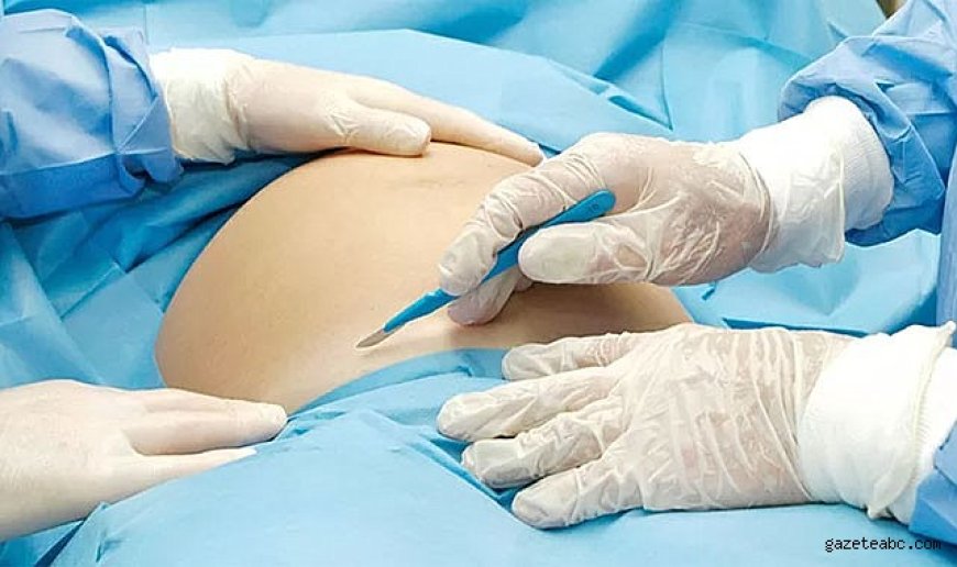 Sezaryen Sonrası Ölümde Doktor Serbest
